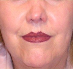 Get Great Control With Dermagen